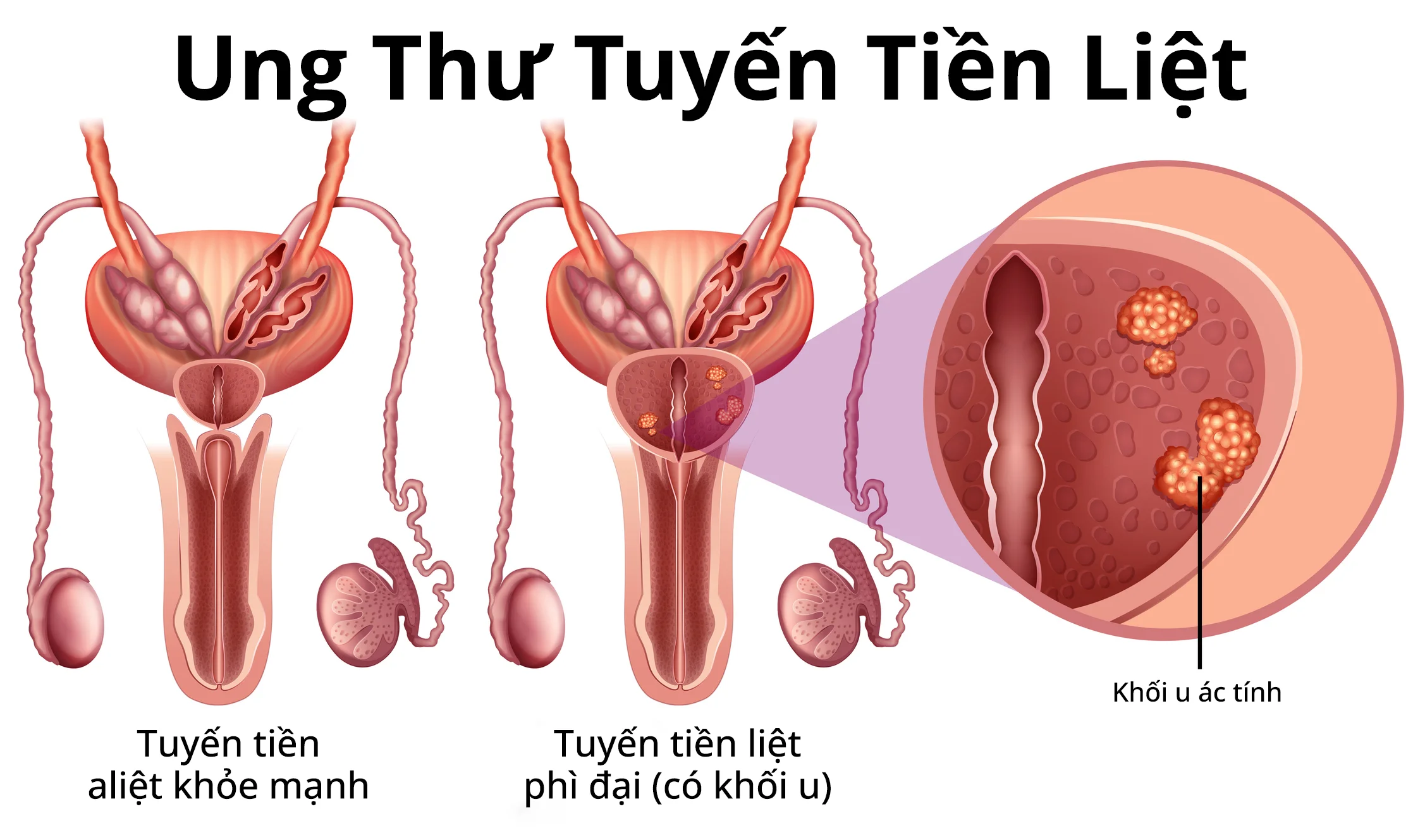 ACTINIUM-225 – BƯỚC TIẾN MỚI TRONG ĐIỀU TRỊ UNG THƯ TUYẾN TIỀN LIỆT DI CĂN